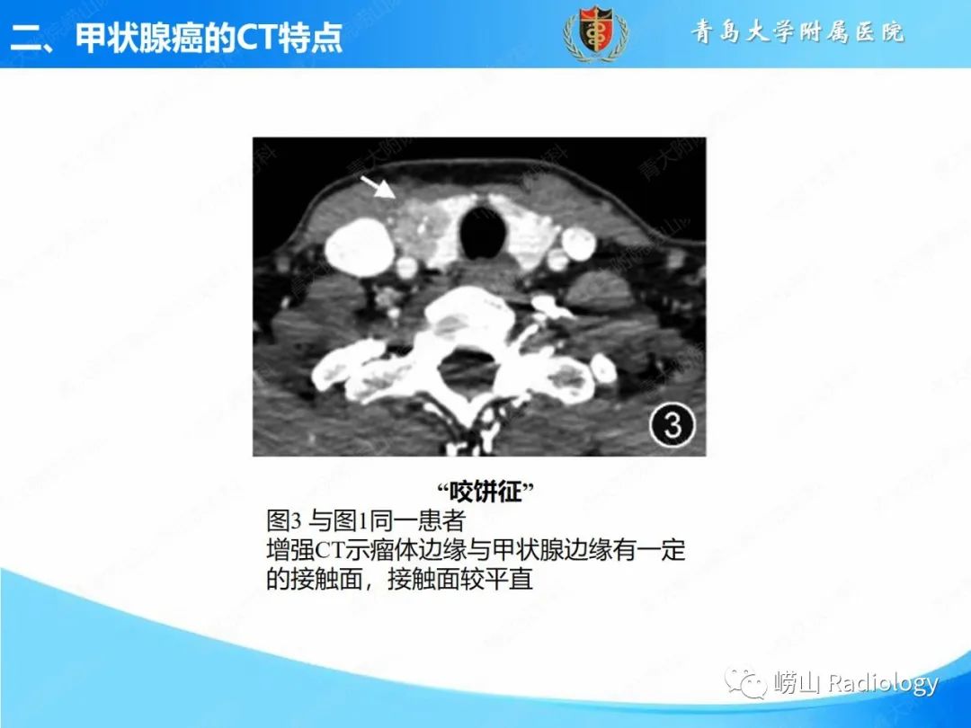 影像PPT - 【PPT】甲状腺癌及其转移淋巴结的影像诊断及鉴别诊断-10
