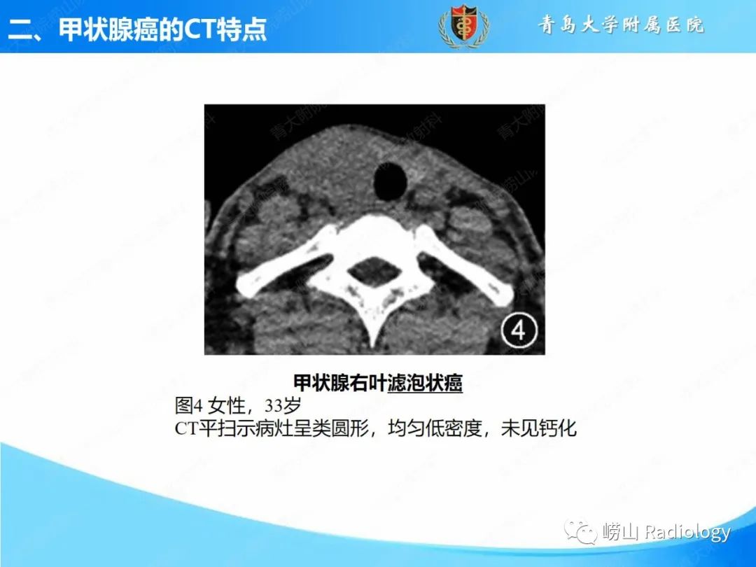 影像PPT - 【PPT】甲状腺癌及其转移淋巴结的影像诊断及鉴别诊断-11
