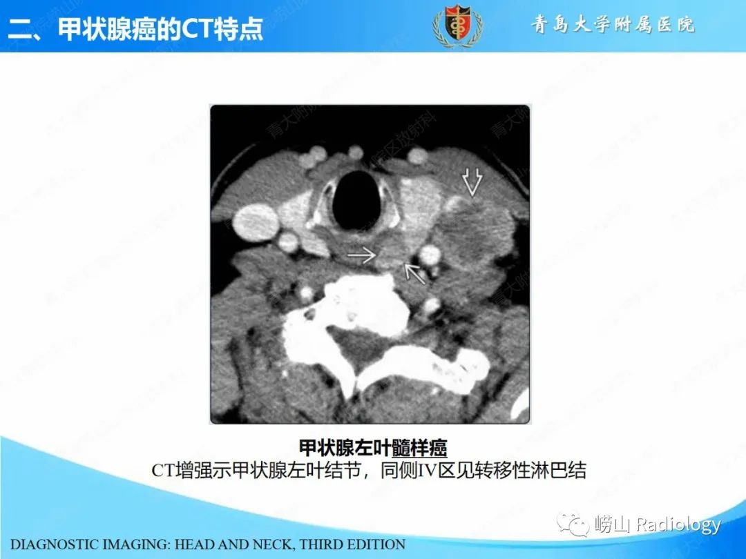 影像PPT - 【PPT】甲状腺癌及其转移淋巴结的影像诊断及鉴别诊断-13