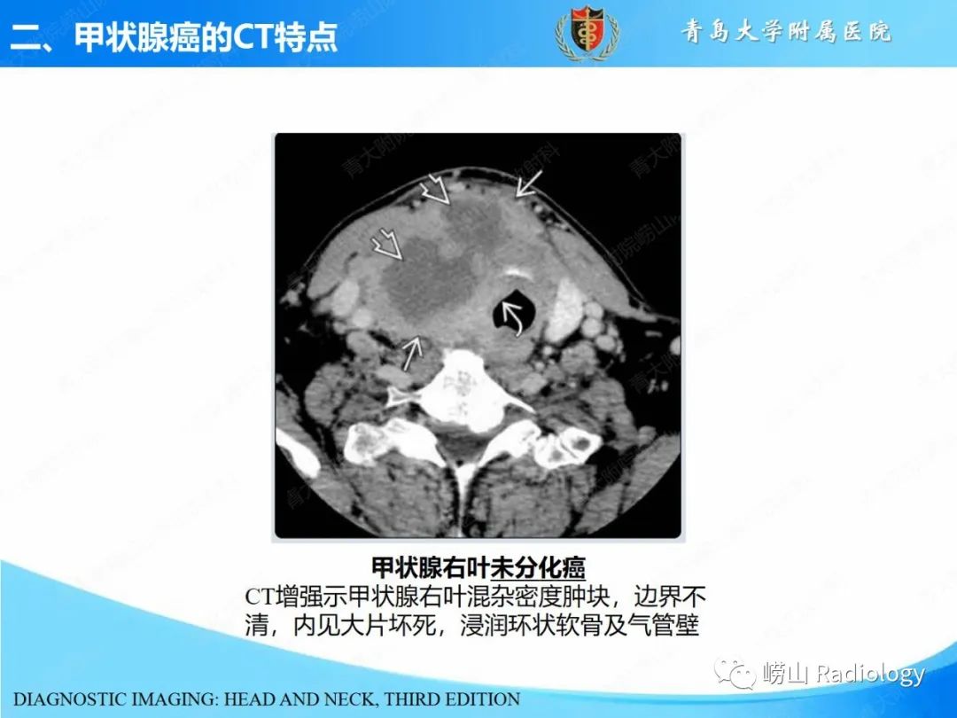 影像PPT - 【PPT】甲状腺癌及其转移淋巴结的影像诊断及鉴别诊断-14