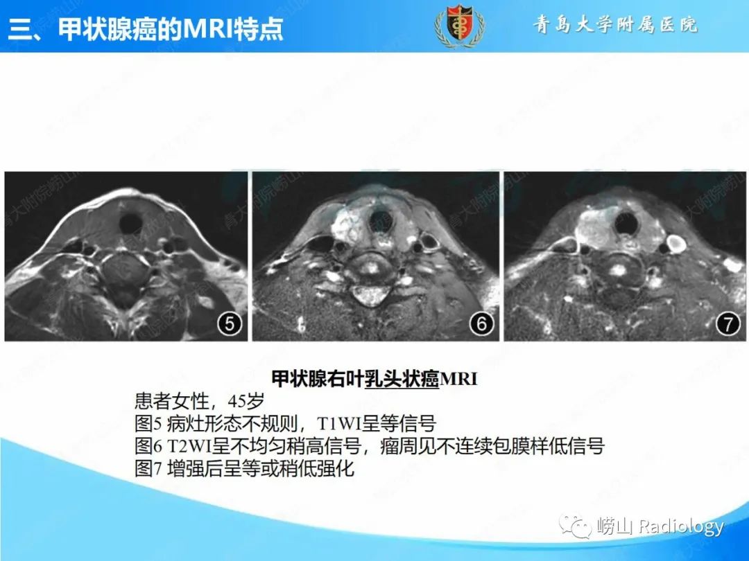影像PPT - 【PPT】甲状腺癌及其转移淋巴结的影像诊断及鉴别诊断-18