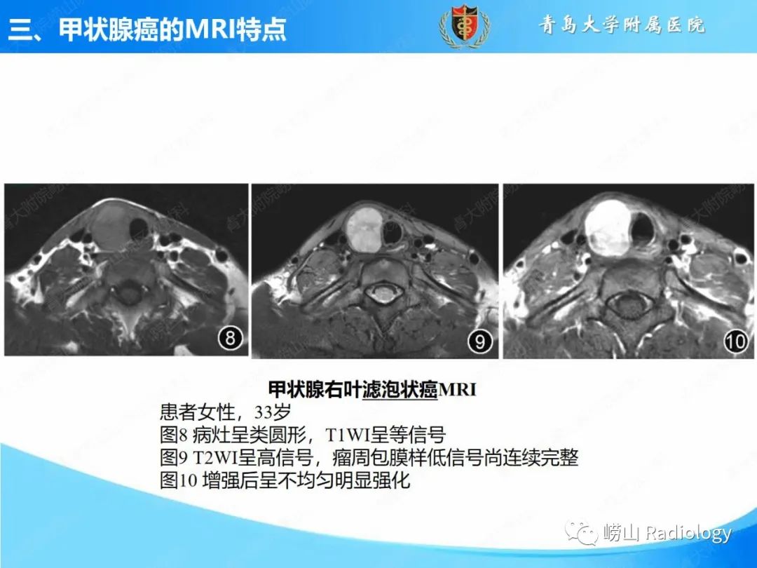 影像PPT - 【PPT】甲状腺癌及其转移淋巴结的影像诊断及鉴别诊断-19