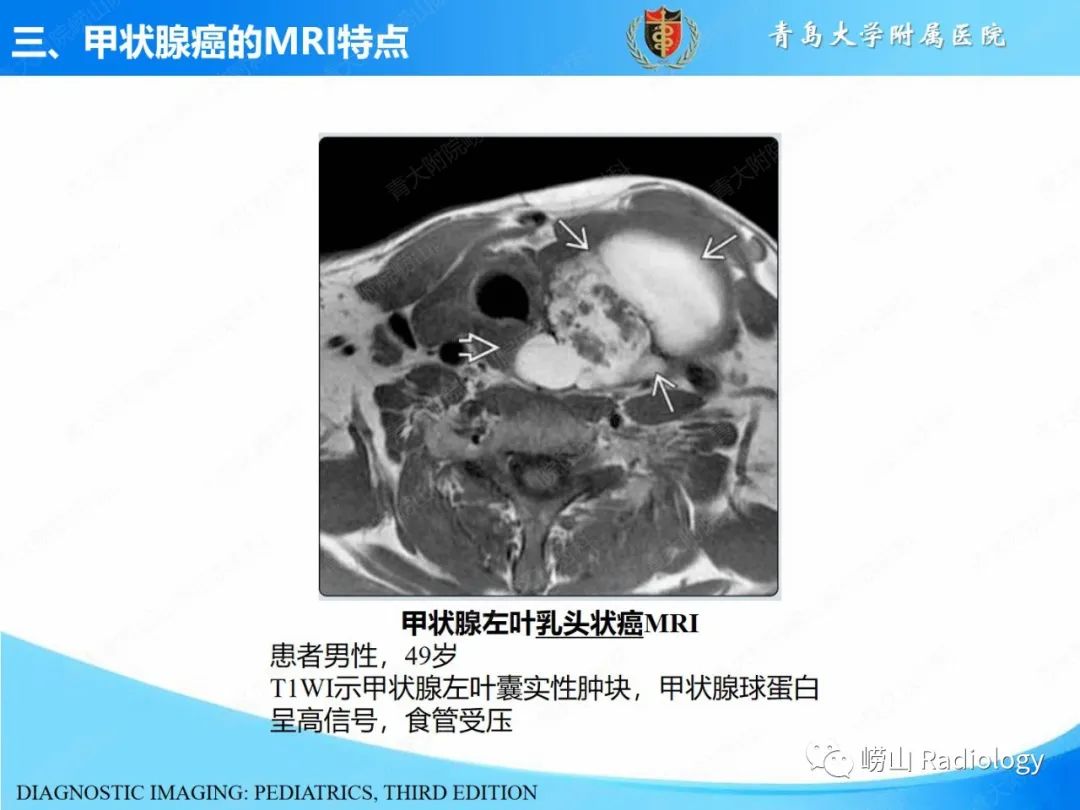 影像PPT - 【PPT】甲状腺癌及其转移淋巴结的影像诊断及鉴别诊断-20