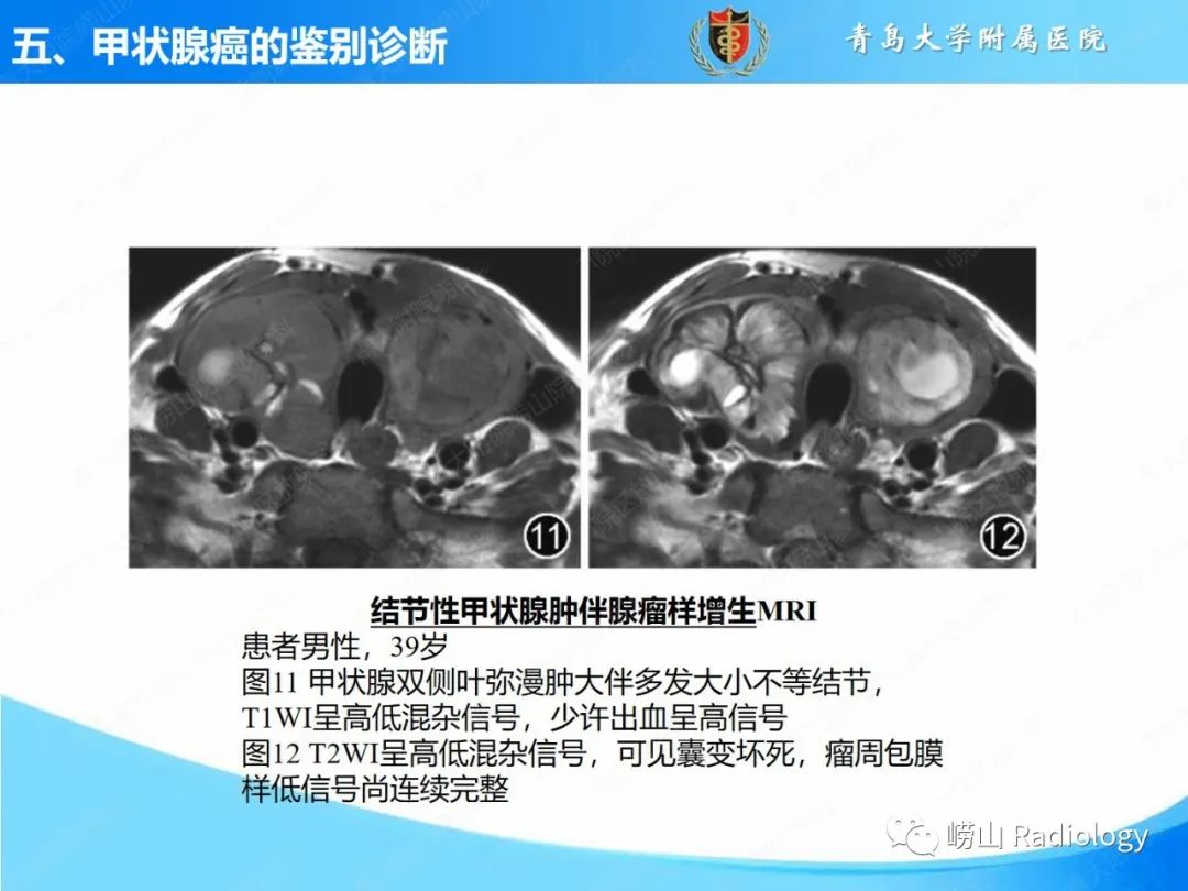 影像PPT - 【PPT】甲状腺癌及其转移淋巴结的影像诊断及鉴别诊断-25