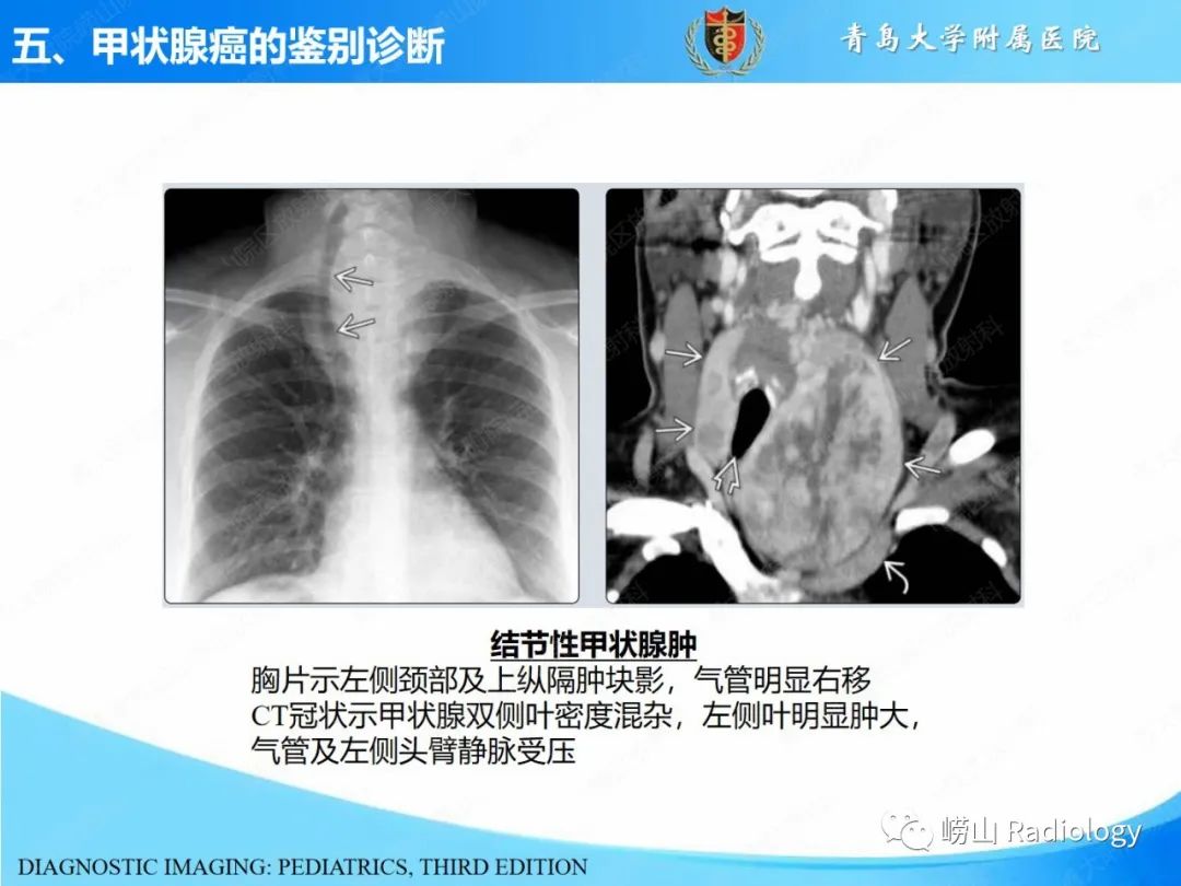 影像PPT - 【PPT】甲状腺癌及其转移淋巴结的影像诊断及鉴别诊断-26