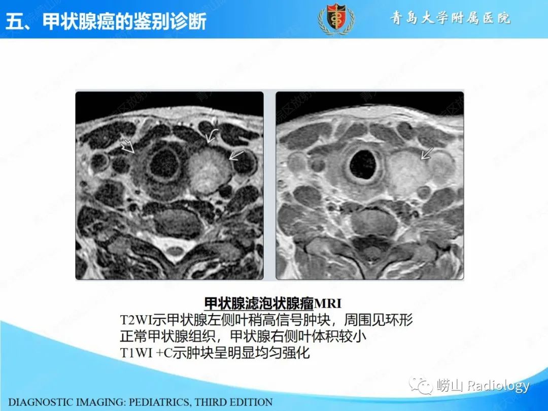 影像PPT - 【PPT】甲状腺癌及其转移淋巴结的影像诊断及鉴别诊断-27