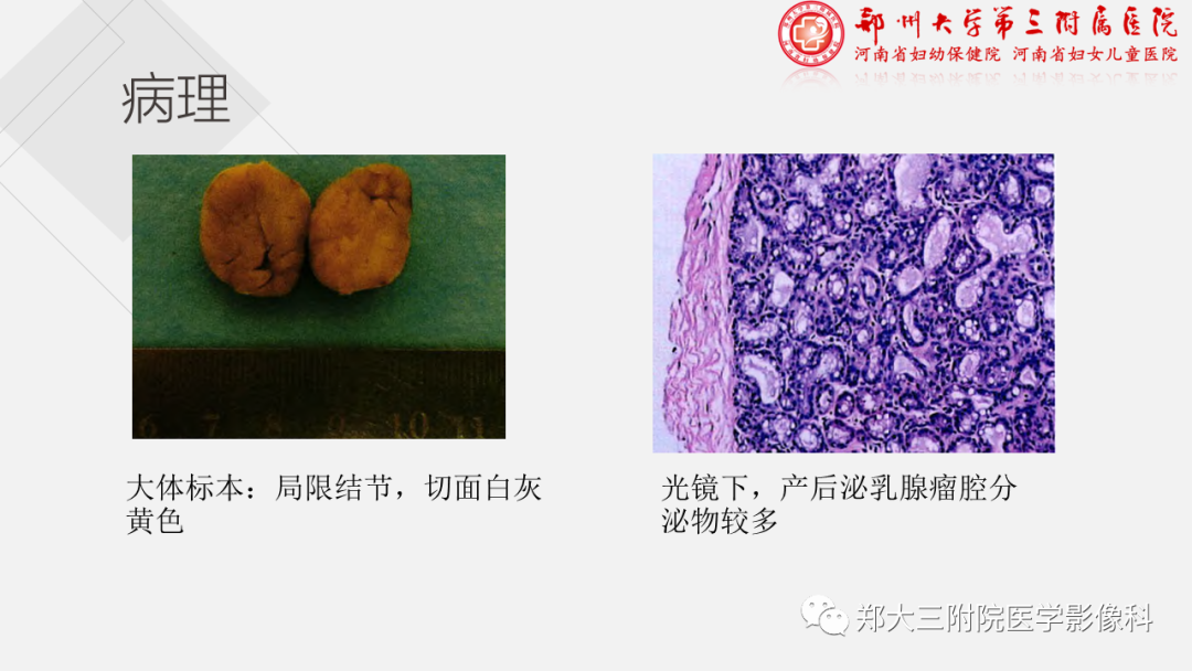 影像PPT - 【PPT】泌乳腺瘤-5