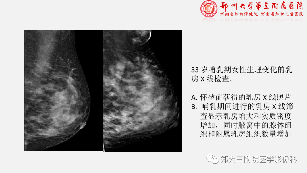 影像PPT - 【PPT】泌乳腺瘤-9