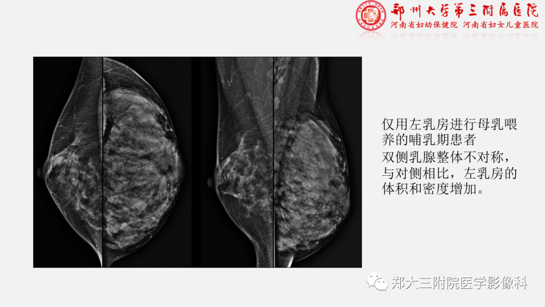 影像PPT - 【PPT】泌乳腺瘤-10