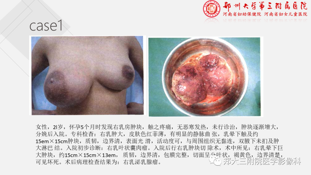 影像PPT - 【PPT】泌乳腺瘤-12