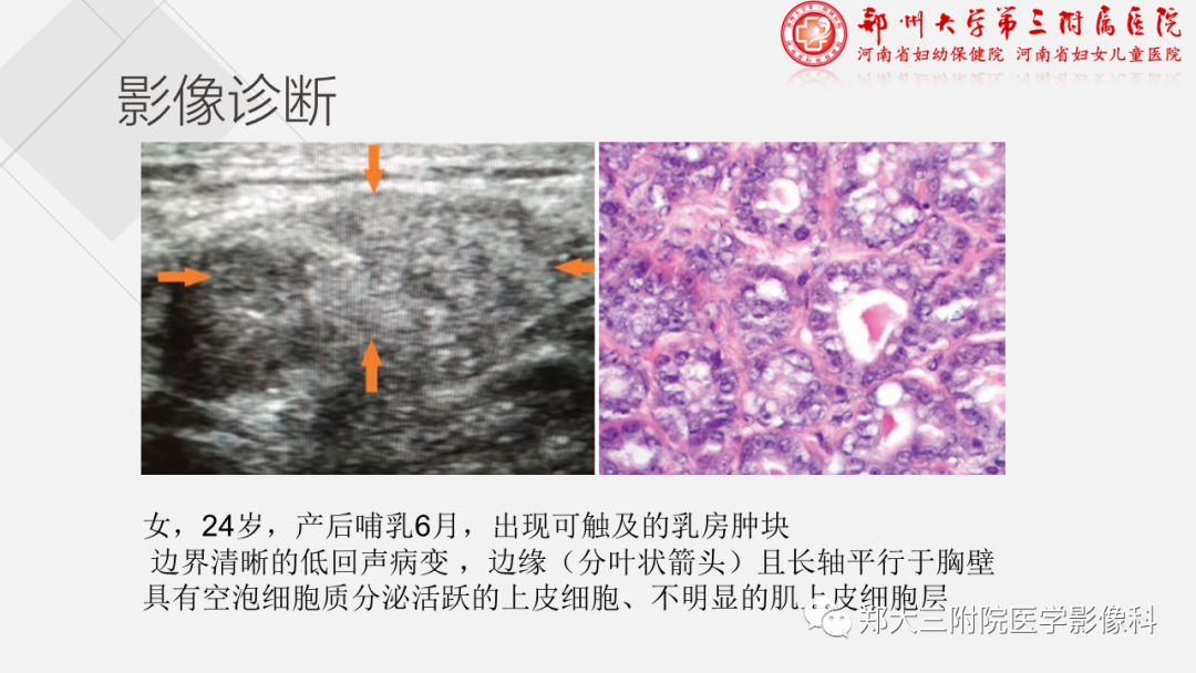 影像PPT - 【PPT】泌乳腺瘤-14