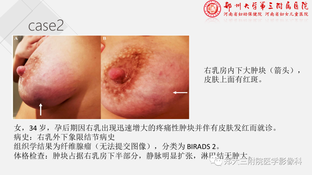 影像PPT - 【PPT】泌乳腺瘤-16