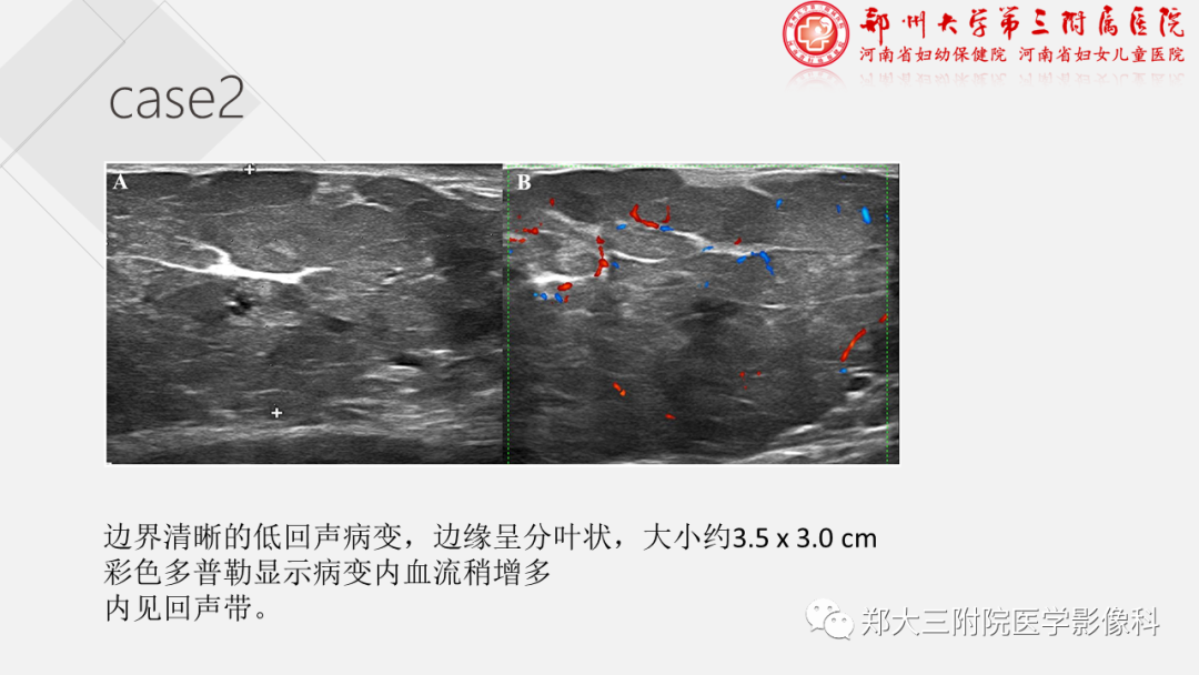 影像PPT - 【PPT】泌乳腺瘤-17