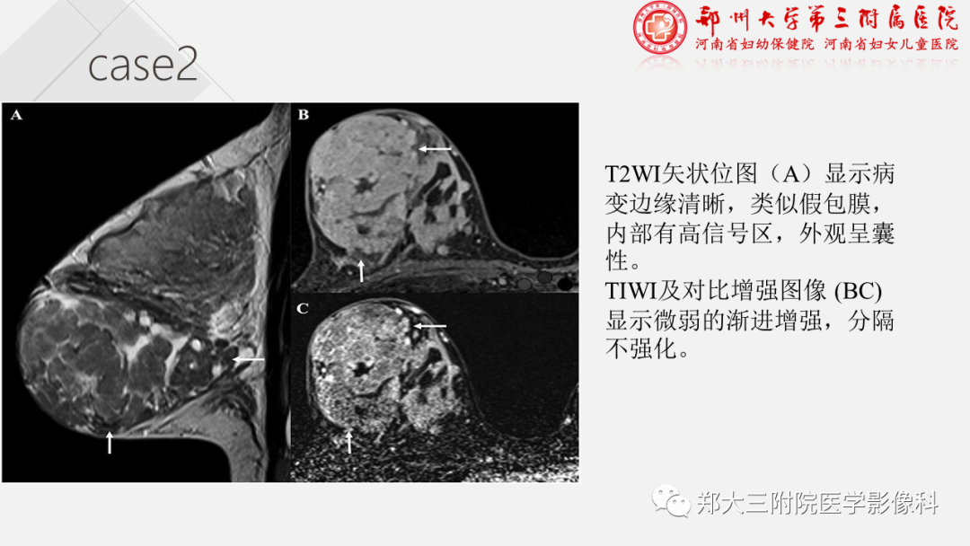 影像PPT - 【PPT】泌乳腺瘤-19