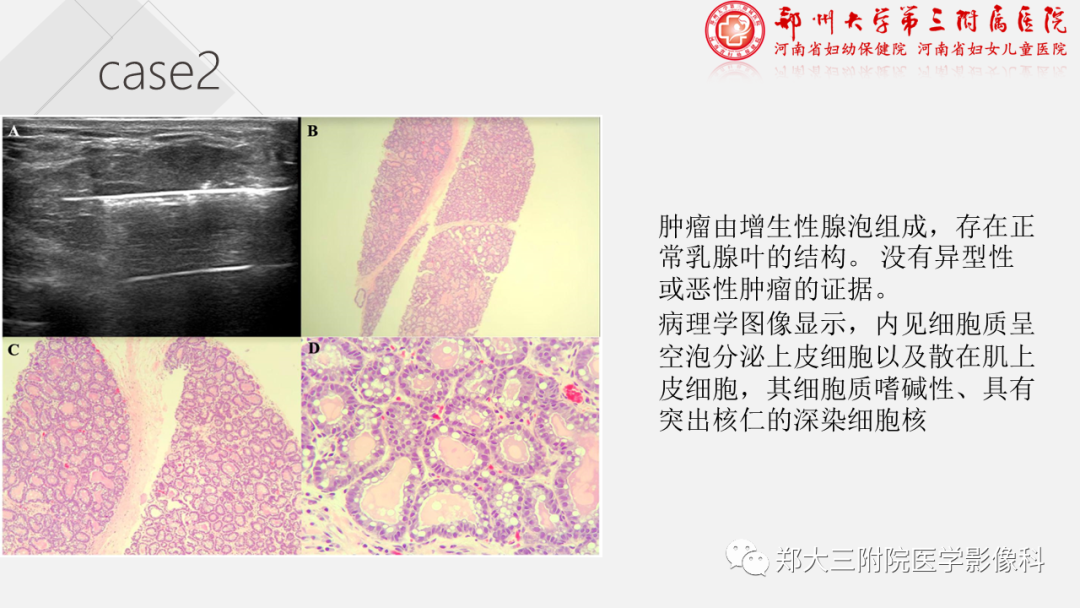 影像PPT - 【PPT】泌乳腺瘤-18