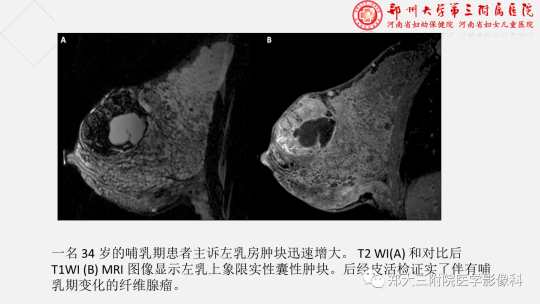 影像PPT - 【PPT】泌乳腺瘤-21