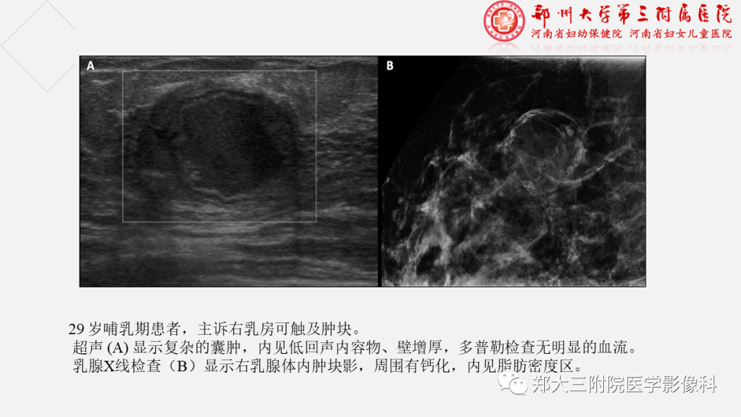 影像PPT - 【PPT】泌乳腺瘤-23