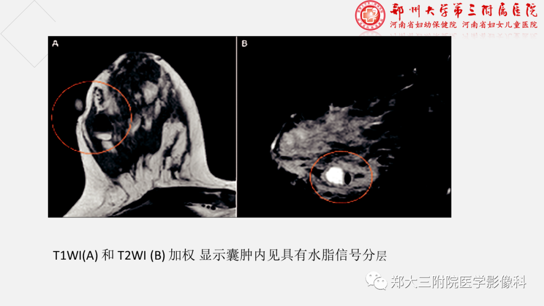 影像PPT - 【PPT】泌乳腺瘤-24
