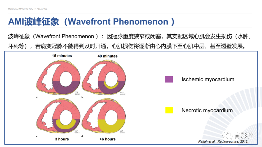 影像PPT - 【PPT】心内膜下延迟强化诊断思路-9