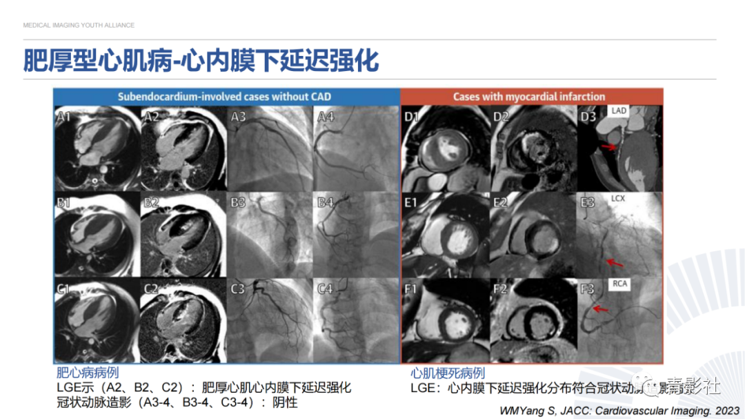 影像PPT - 【PPT】心内膜下延迟强化诊断思路-16