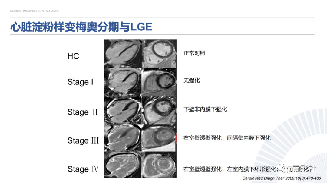 影像PPT - 【PPT】心内膜下延迟强化诊断思路-27