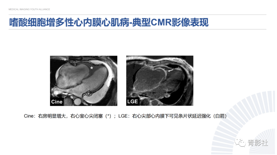 影像PPT - 【PPT】心内膜下延迟强化诊断思路-44