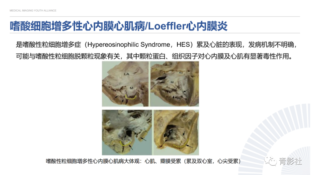 影像PPT - 【PPT】心内膜下延迟强化诊断思路-42