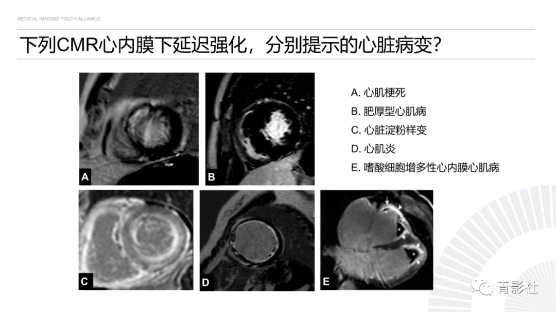 影像PPT - 【PPT】心内膜下延迟强化诊断思路-45