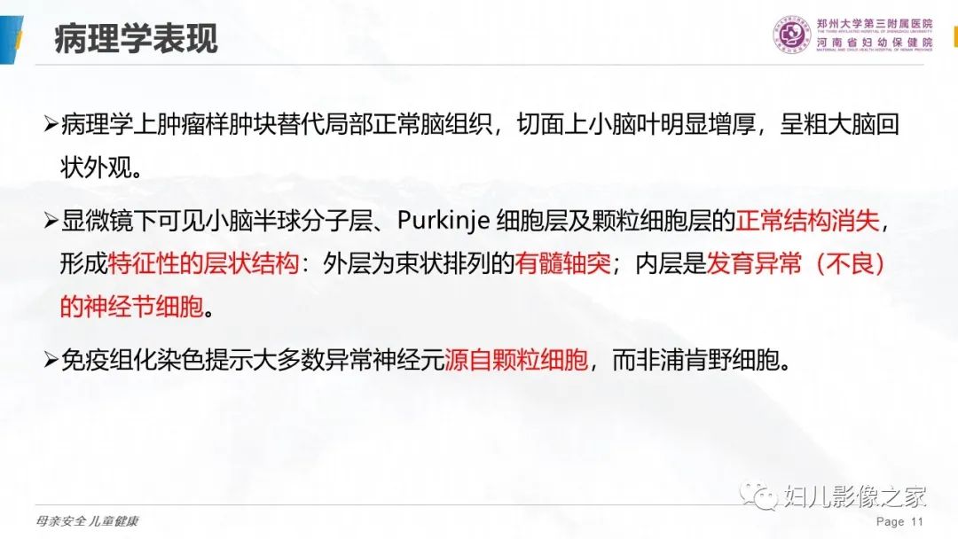 影像PPT - 【PPT】小脑发育不良性神经节细胞瘤的影像诊断-11
