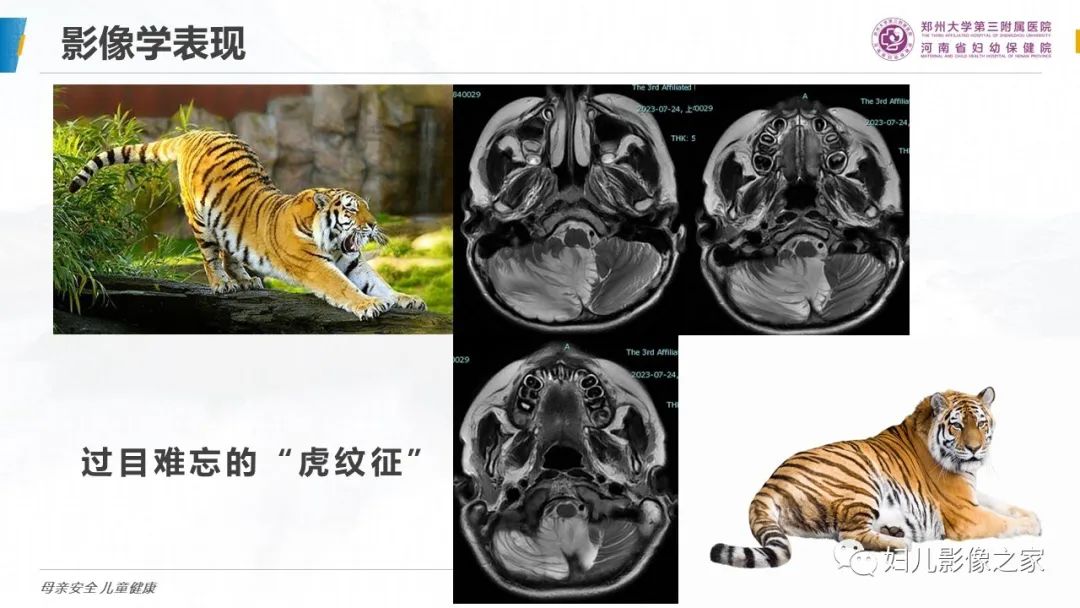 影像PPT - 【PPT】小脑发育不良性神经节细胞瘤的影像诊断-14