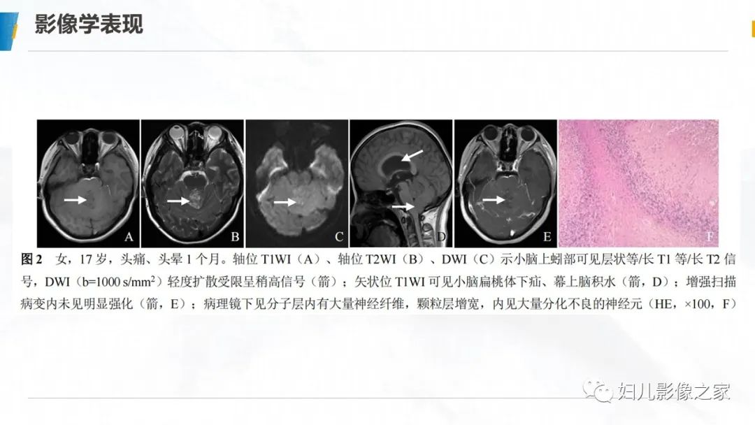 影像PPT - 【PPT】小脑发育不良性神经节细胞瘤的影像诊断-16