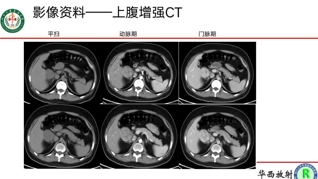 影像PPT - 【病例】腹膜后Castleman病1例CT影像-4