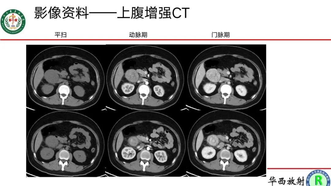 影像PPT - 【病例】腹膜后Castleman病1例CT影像-6