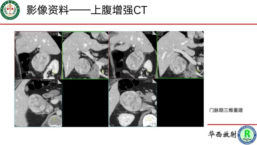 影像PPT - 【病例】腹膜后Castleman病1例CT影像-7