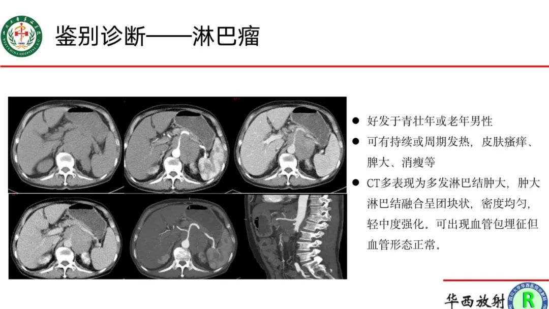 影像PPT - 【病例】腹膜后Castleman病1例CT影像-14
