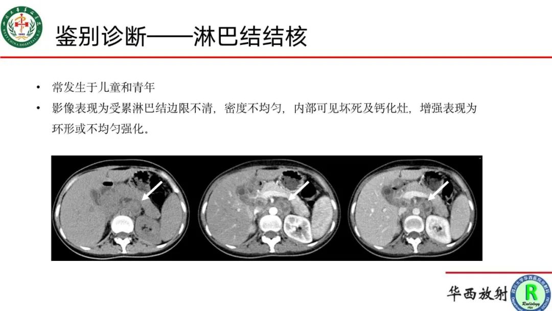 影像PPT - 【病例】腹膜后Castleman病1例CT影像-15