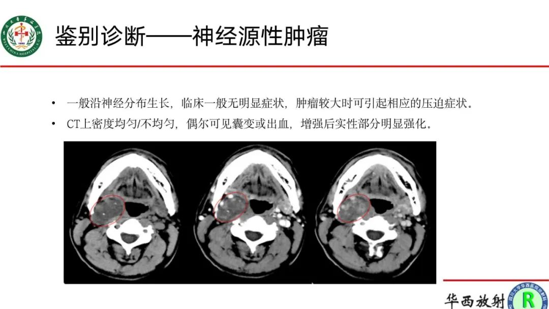 影像PPT - 【病例】腹膜后Castleman病1例CT影像-16