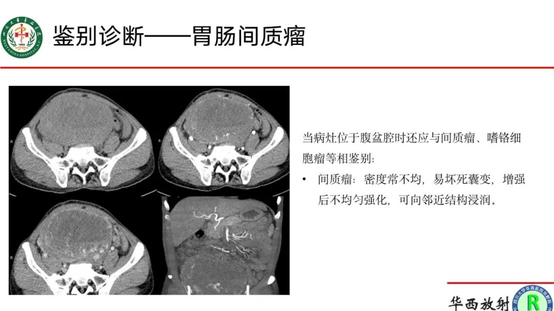 影像PPT - 【病例】腹膜后Castleman病1例CT影像-17