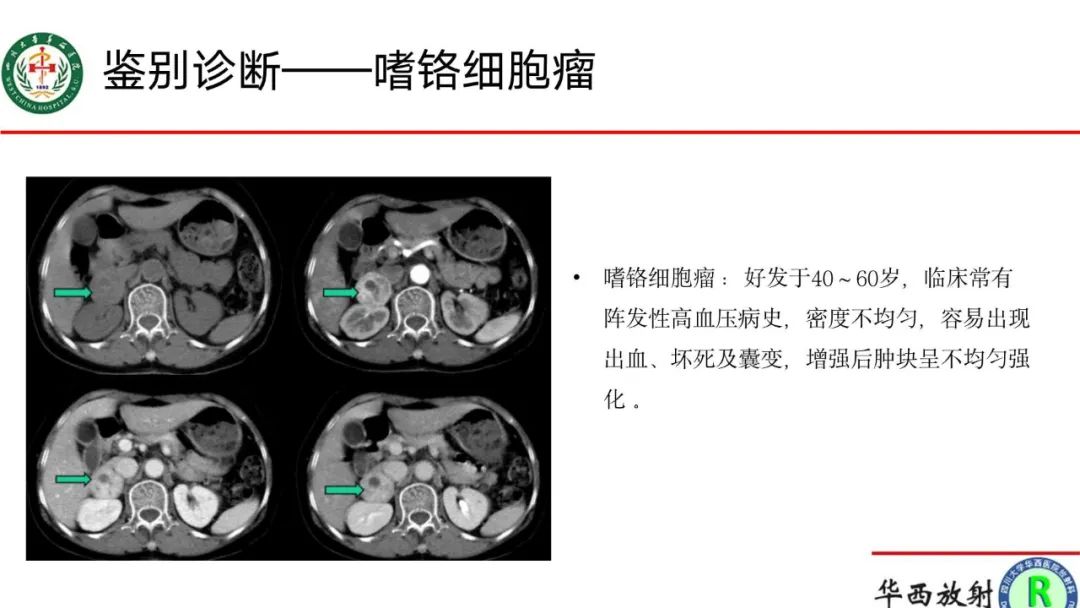影像PPT - 【病例】腹膜后Castleman病1例CT影像-18