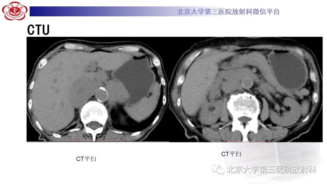 影像PPT - 【PPT】肾脏淋巴瘤-4