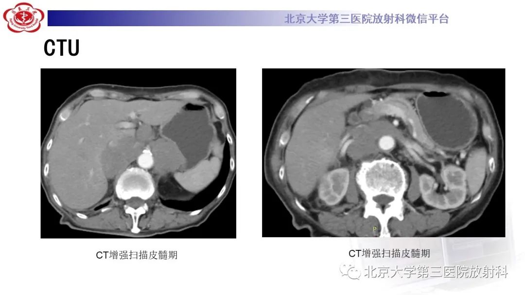 影像PPT - 【PPT】肾脏淋巴瘤-6