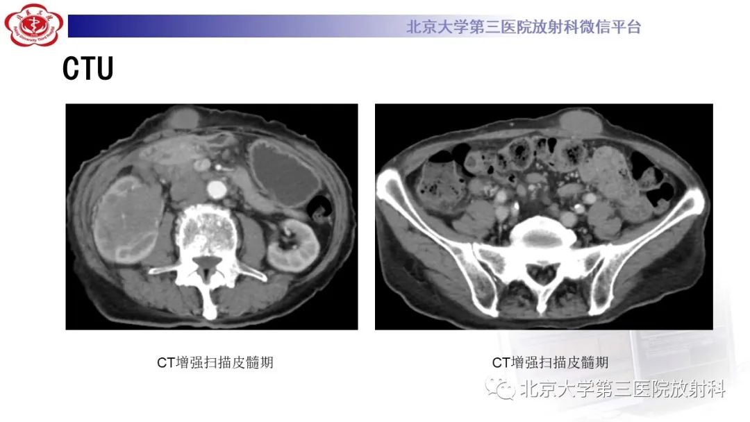 影像PPT - 【PPT】肾脏淋巴瘤-7