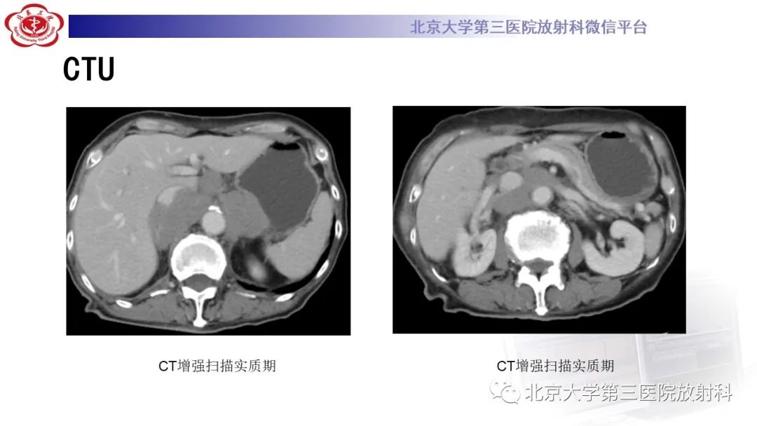 影像PPT - 【PPT】肾脏淋巴瘤-8