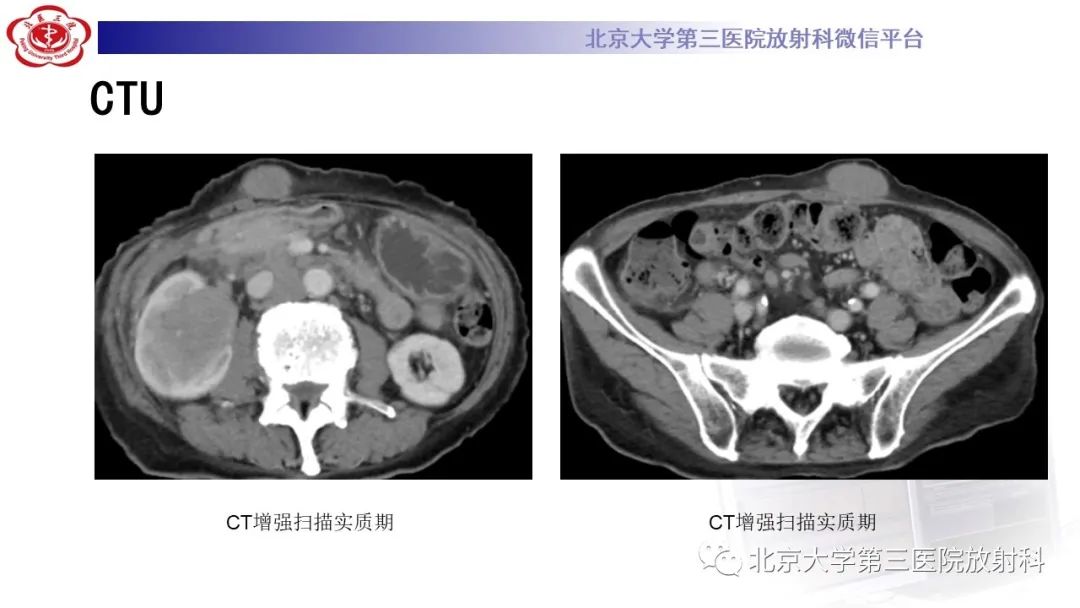 影像PPT - 【PPT】肾脏淋巴瘤-9