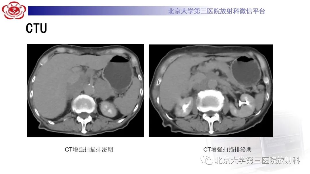影像PPT - 【PPT】肾脏淋巴瘤-10
