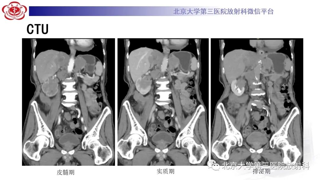 影像PPT - 【PPT】肾脏淋巴瘤-11