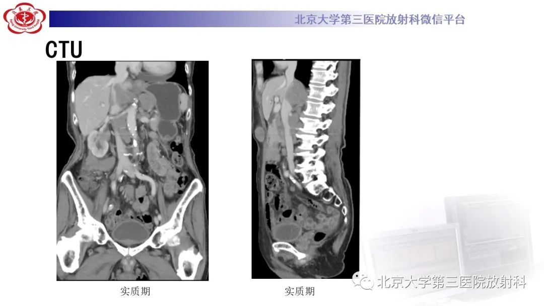 影像PPT - 【PPT】肾脏淋巴瘤-13
