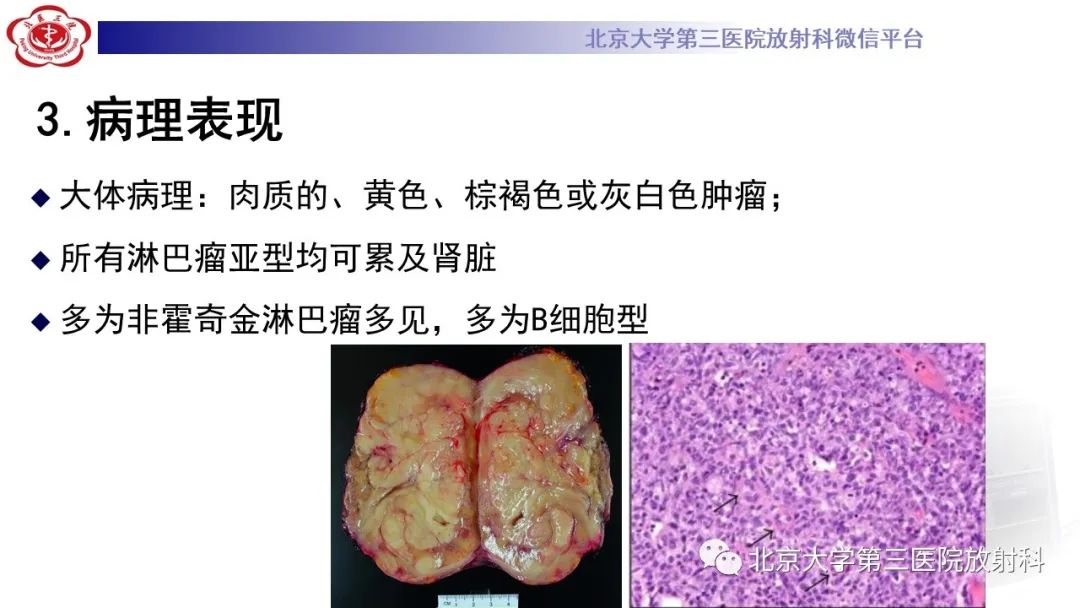 影像PPT - 【PPT】肾脏淋巴瘤-19