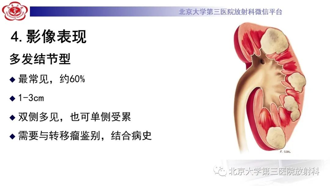 影像PPT - 【PPT】肾脏淋巴瘤-22