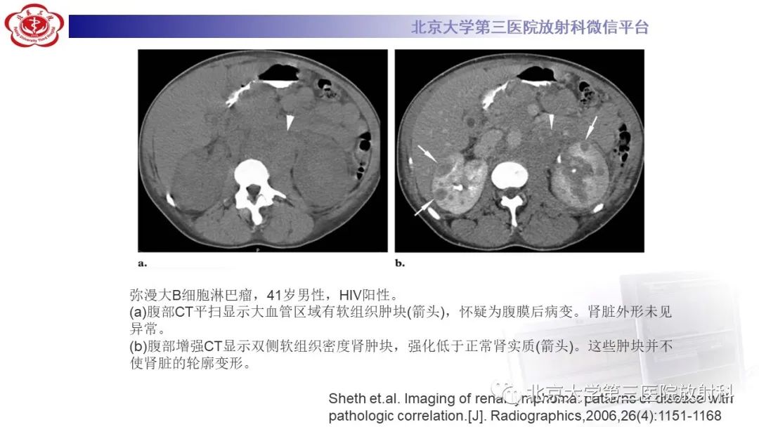 影像PPT - 【PPT】肾脏淋巴瘤-23